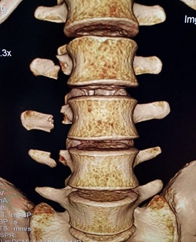 toni bou vertebrae